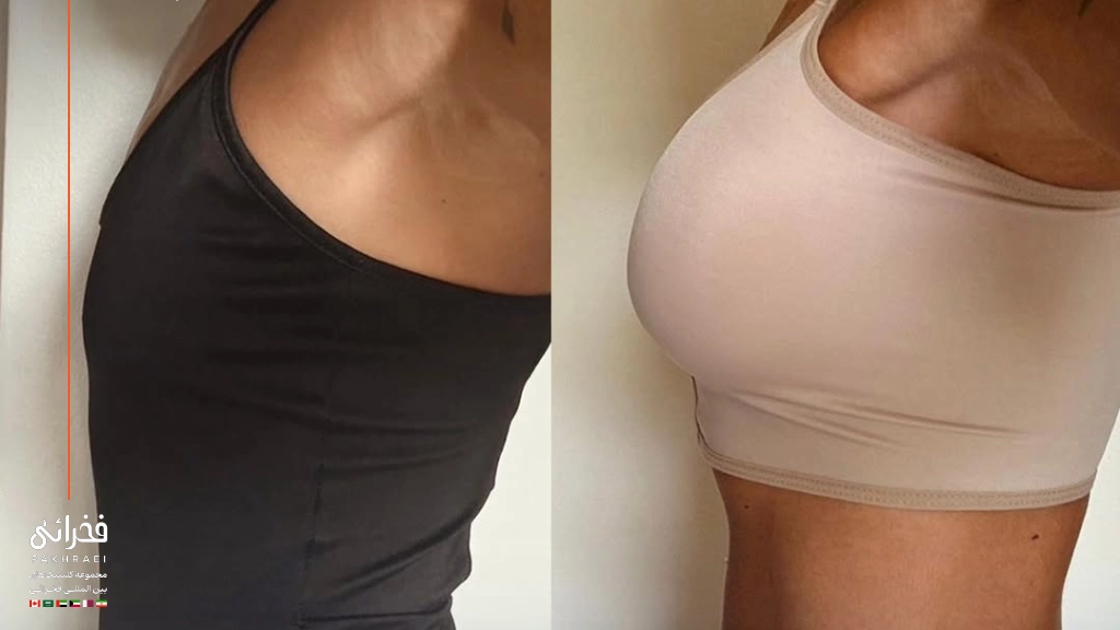 فیلر بادی برای سینه