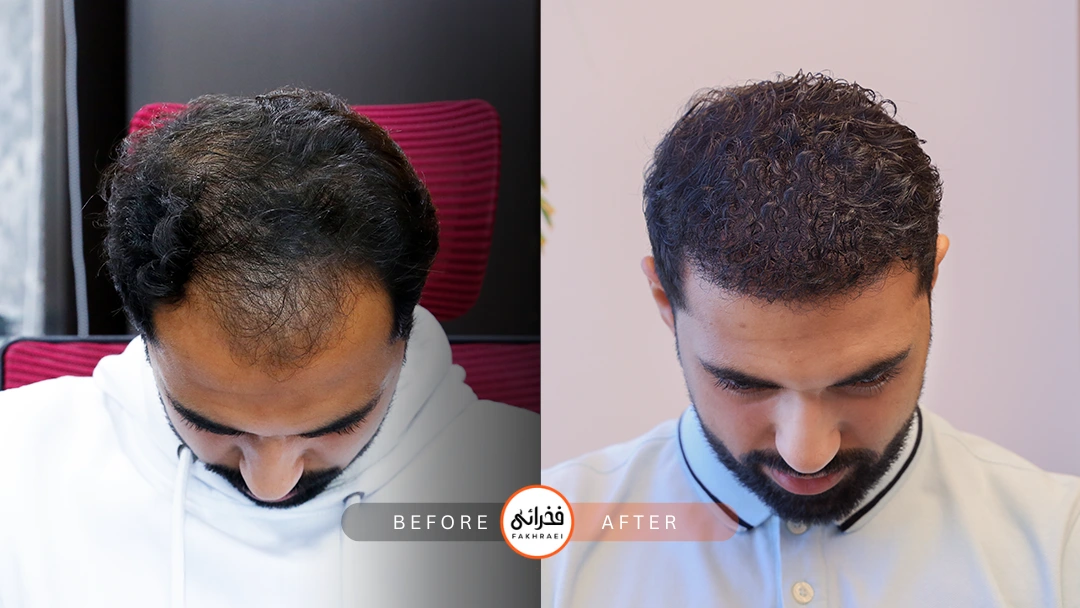 عکس قبل و بعد از کاشت مو