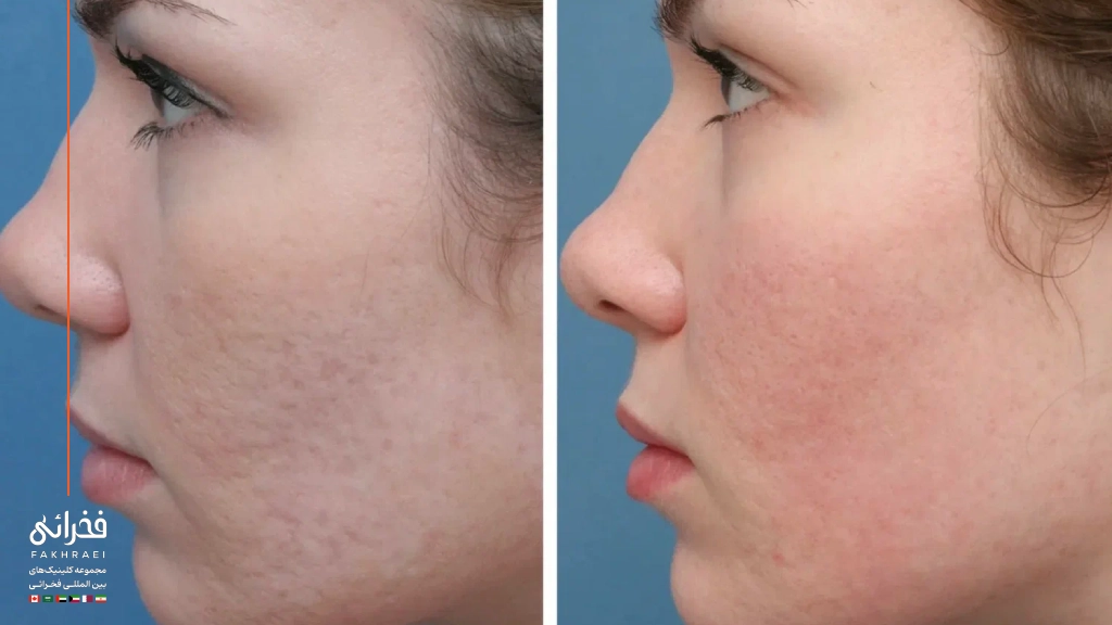 عکس قبل و بعد سابسیژن صورت