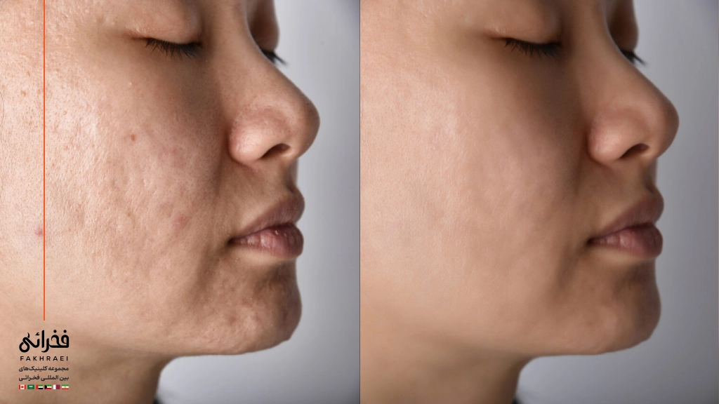 عکس قبل و بعد از سابسیژن