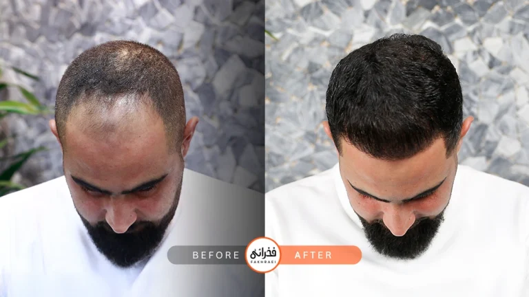 عکس کاشت مو