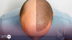 کاشت مو با تراکم بالا