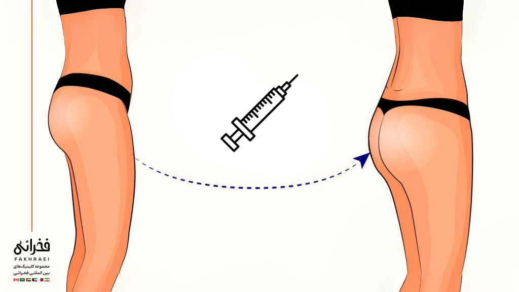 فیلر باسن چیست؟