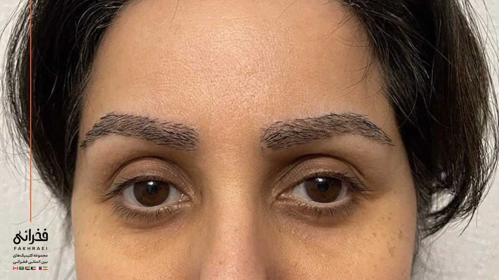 ریزش ابرو بعد از کاشت