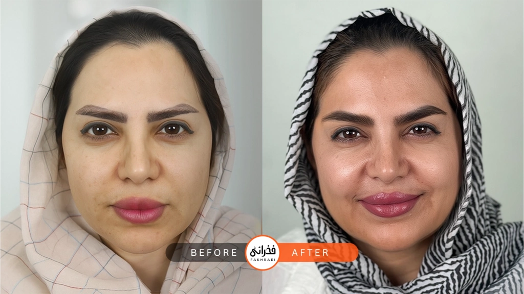 عکس قبل و بعد از کاشت ابرو