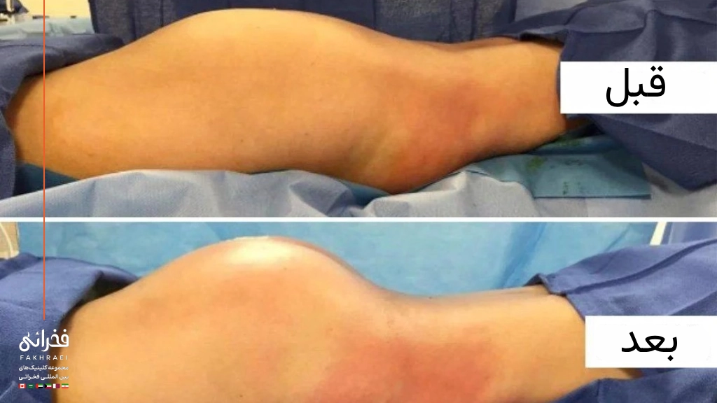 عکس قبل و بعد از تزریق چربی به باسن