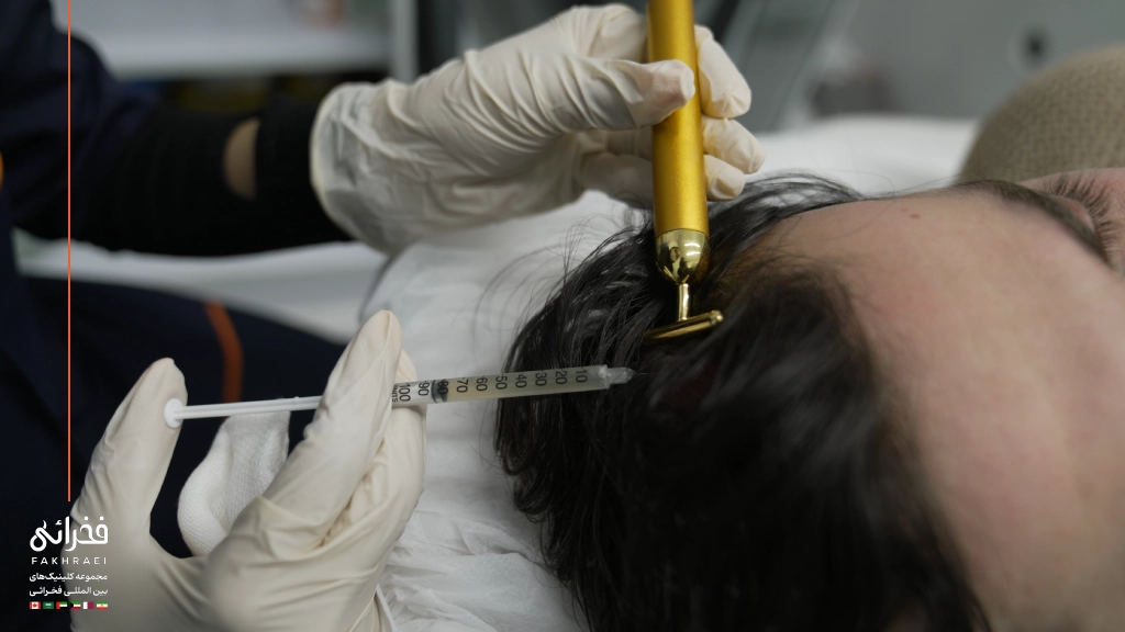 تزریق پی آر پی مو