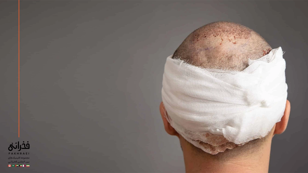 ۱۴ روز بعد از کاشت مو ممکن است شاهد چه عوارضی باشیم؟