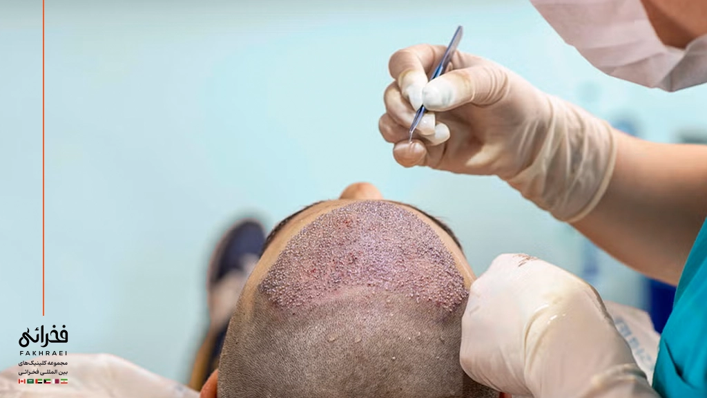 وضعیت موهای کاشته‌شده در ۱۴ روز پس از کاشت