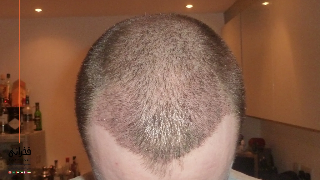 تغذیه مناسب ۱۴ روز بعد از کاشت مو