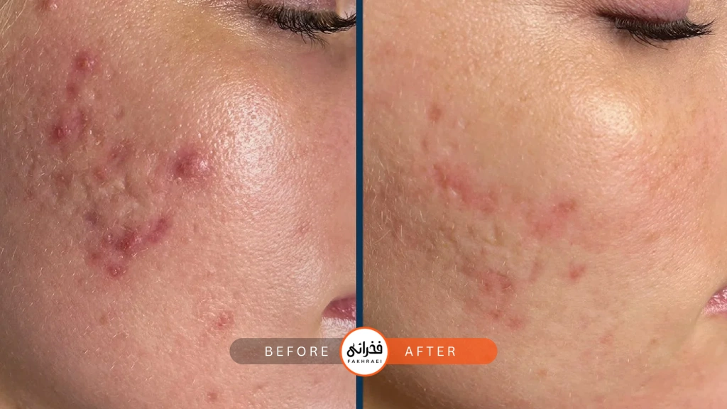 اگزوزوم برای جای جوش