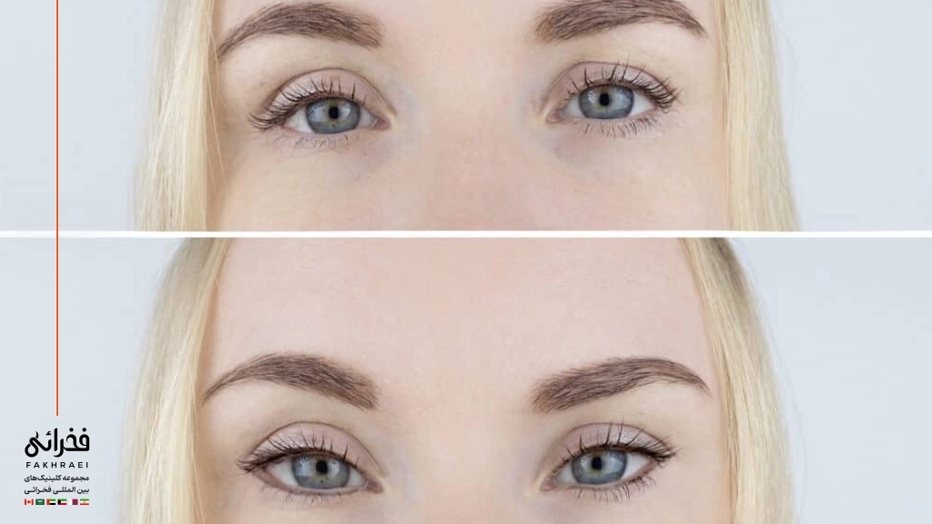 تغییرات چهره پس از لیفت چشم روباهی