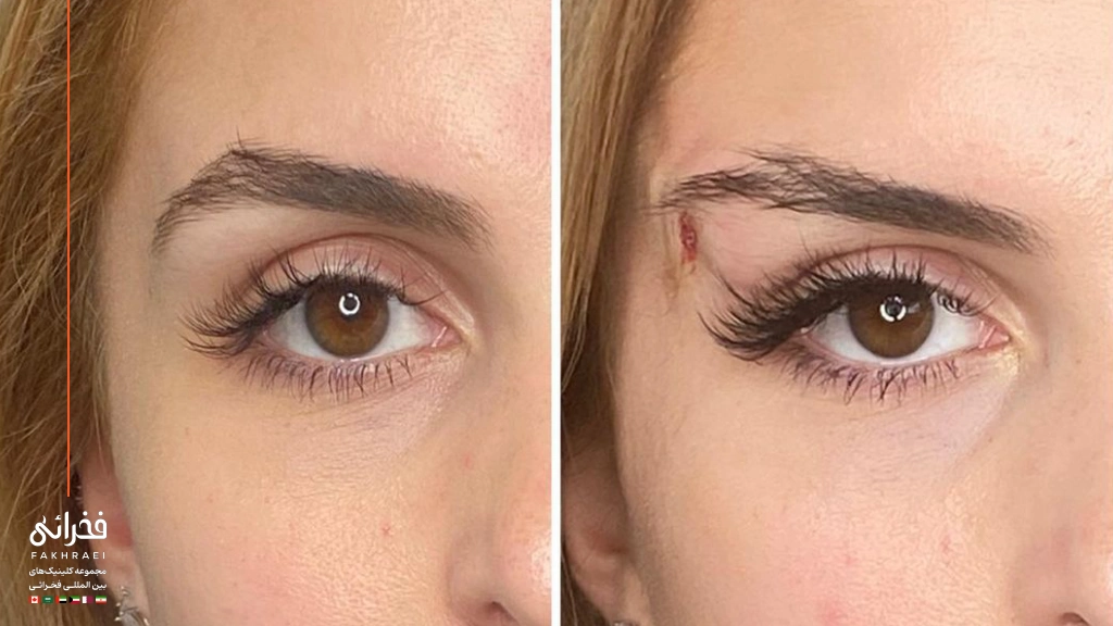 لیفت چشم روباهی