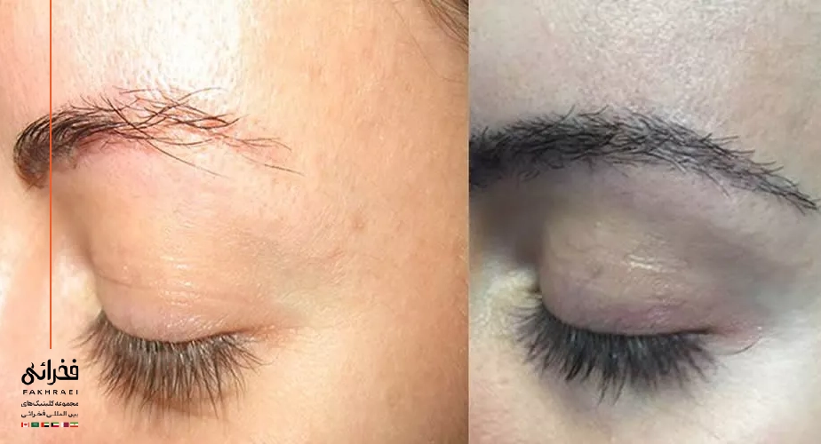 علت سیخ شدن ابرو بعد از کاشت