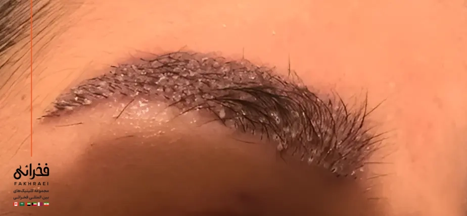 آیا سیخ شدن ابرو پس از کاشت طبیعی است؟
