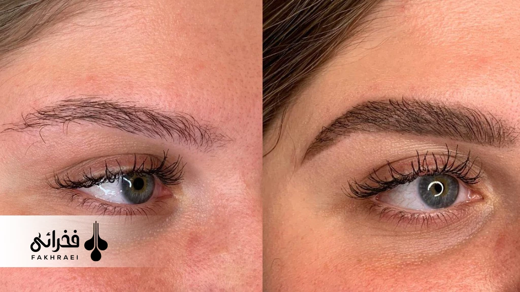 آیا کاشت ابرو دائمی است؟