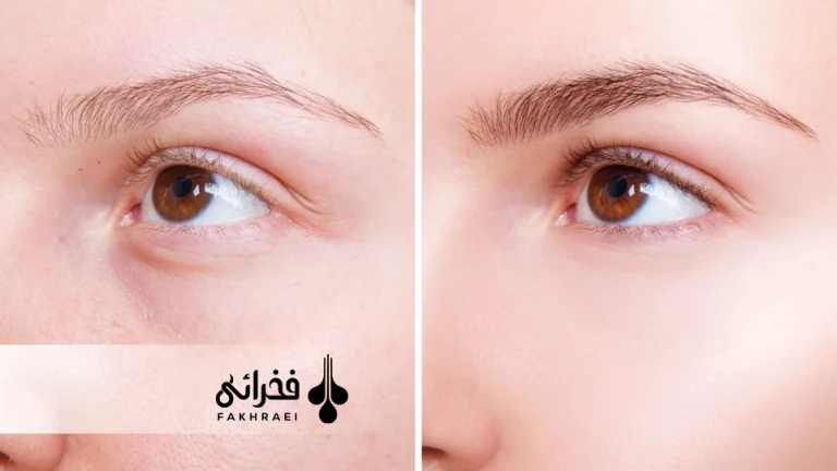 ماندگاری کاشت ابرو