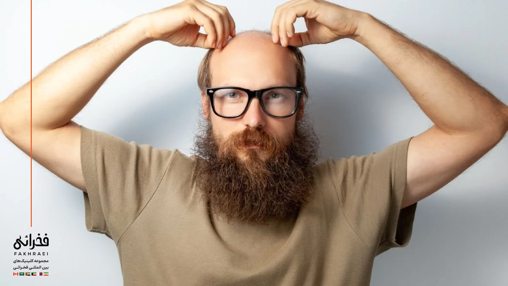 افراد واجد شرایط برای کاشت مو از ریش