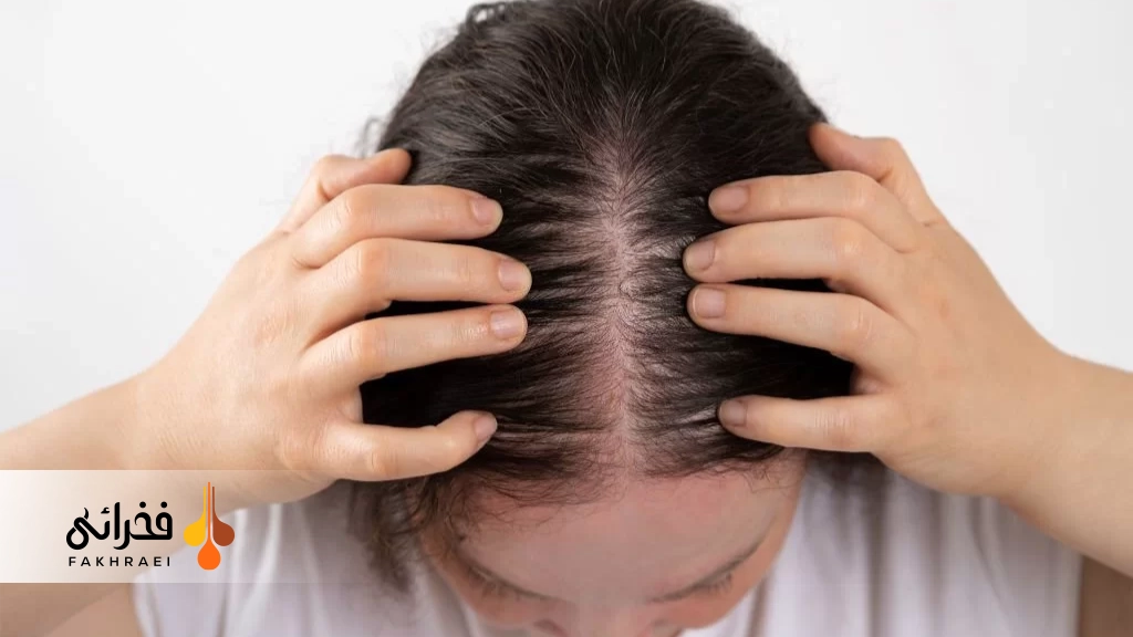 الگو ریزش مو ناشی از سندروم تخمدان