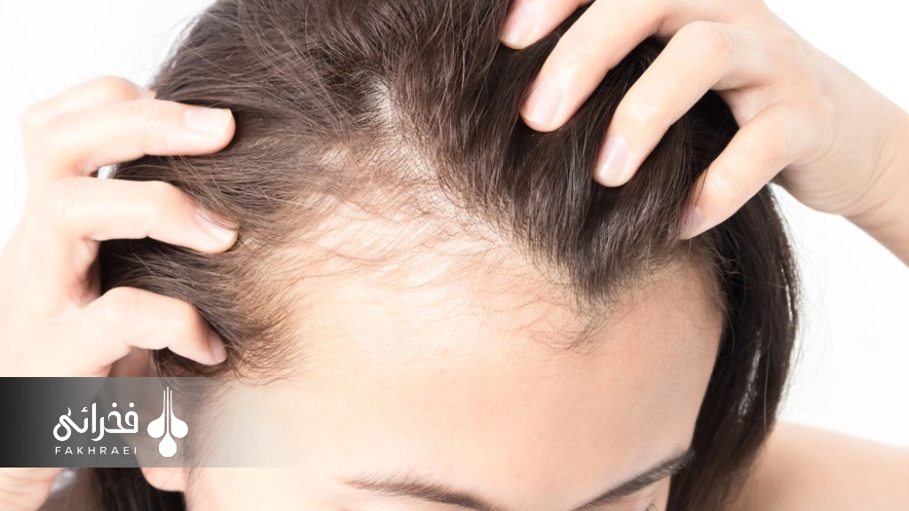 درمان ریزش مو ناشی از سندروم تخمدان