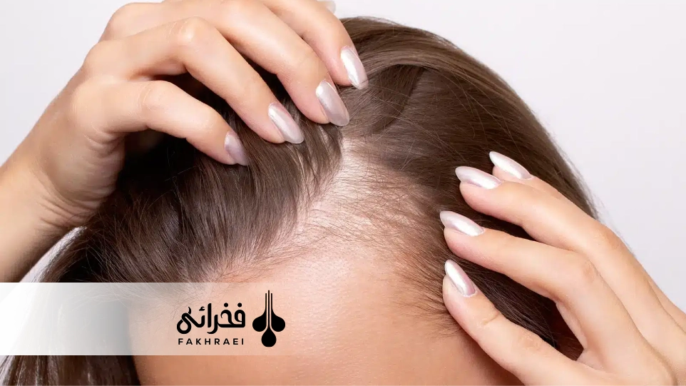 ریزش مو ناشی از سندرم تخمدان