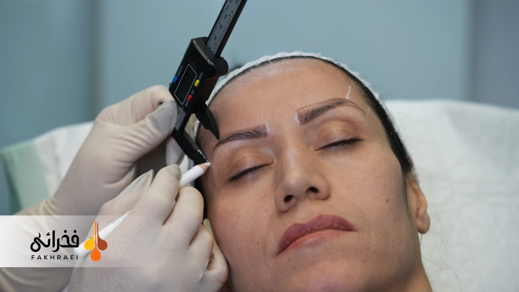 مراحل کاشت ابرو به روش NTF 