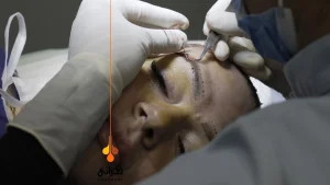 کاشت مو به روش NTF