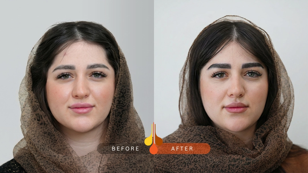 تصویر قبل و بعد کاشت ابرو