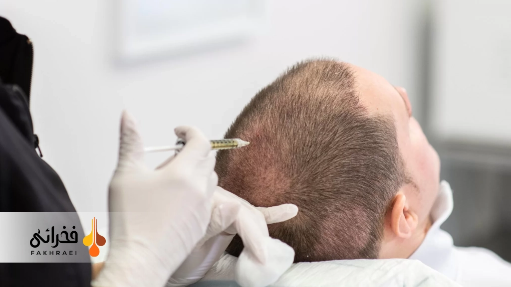 عوارض مزوتراپی مو بعد از کاشت