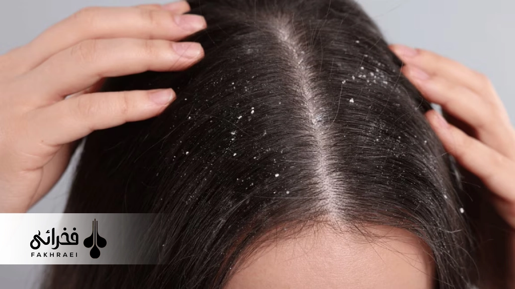 شامپو کتوکونازول برای شوره سر