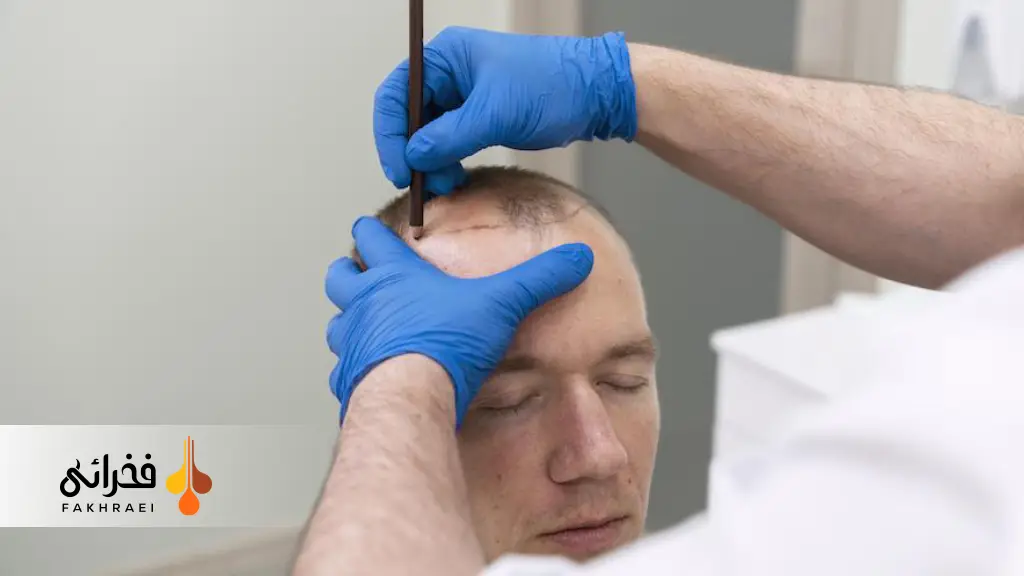 ویژگی های بهترین دکتر کاشت مو در ایران