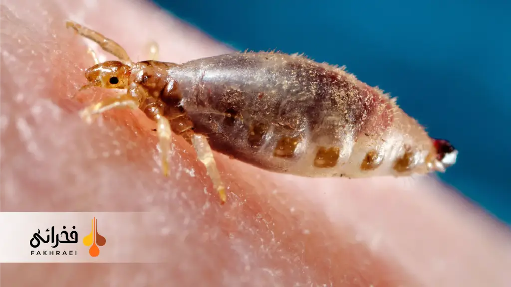 شپش سر چیست و چرا به‌وجود می‌آید؟