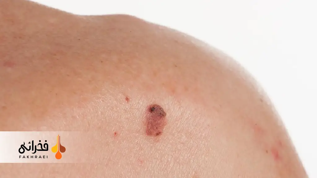 خال سرطانی یا خال خطرناک