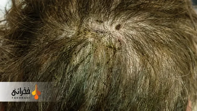 قارچ سیاه مو (Black Piedra) چیست؟