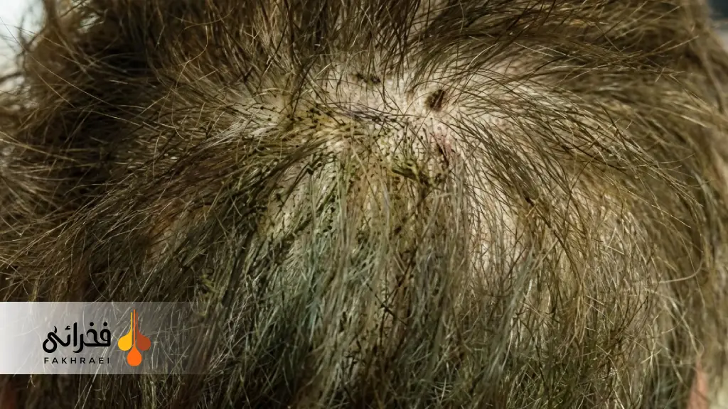 قارچ سیاه مو (Black Piedra) چیست؟