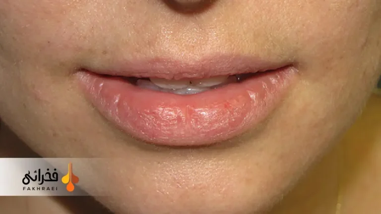 شیلیت اکتینیک چیست؟