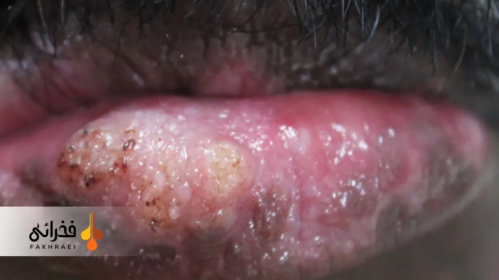 شیلیت اکتینیک چیست؟