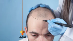 کاشت مو به روش DHI