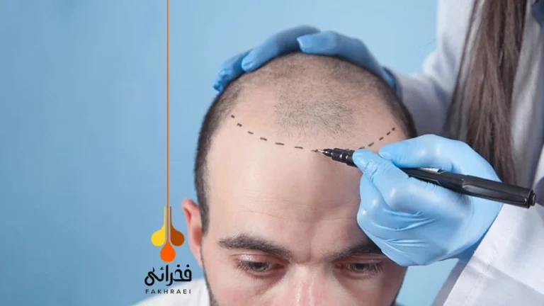 کاشت مو به روش DHI