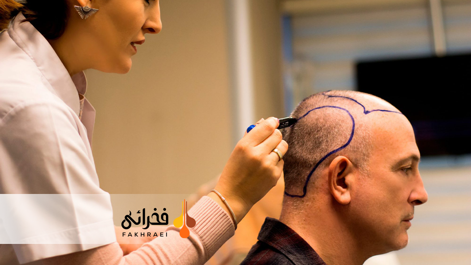 کاشت مو به روش DHI