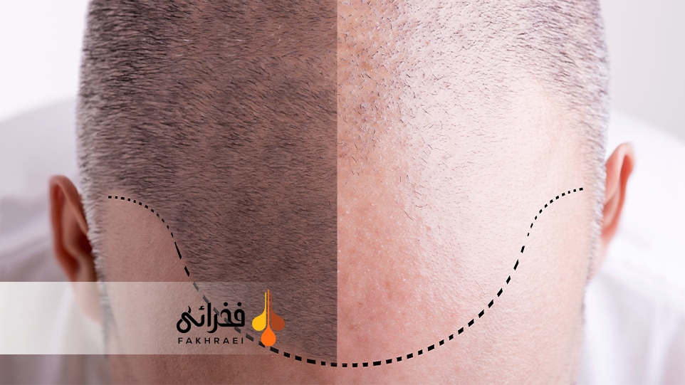 تصویر قبل و بعد کاشت مو به روش DHI