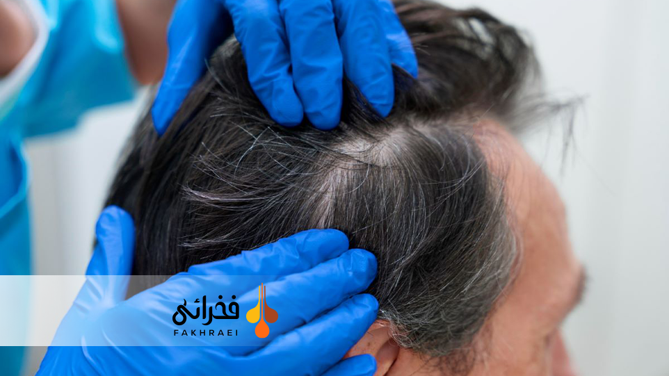 چه کسانی کاندید مناسب کاشت مو به روش DHI