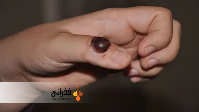 گرانولوم چیست؟