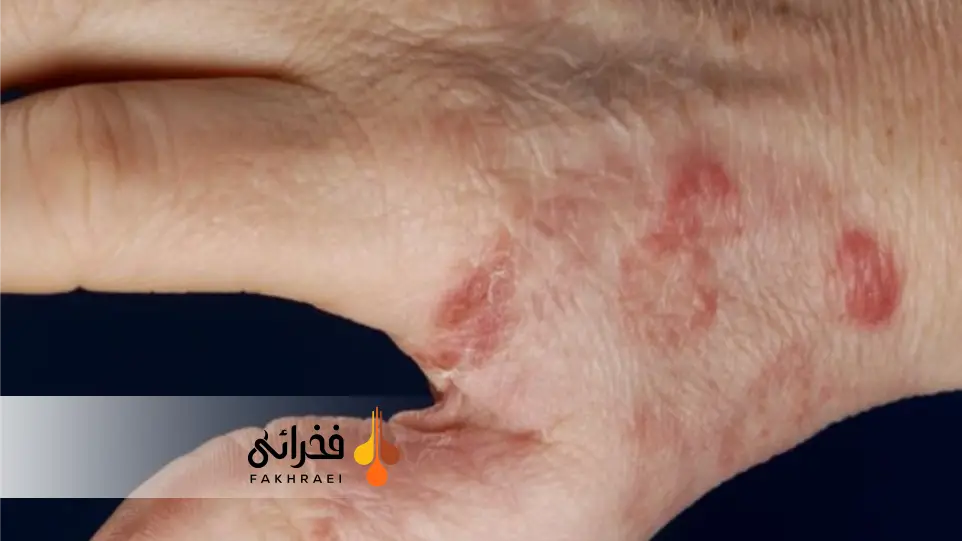 نشانه های ظاهری گرانالوم