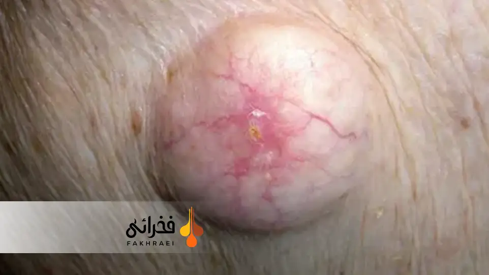 کیست کراتین چیست؟