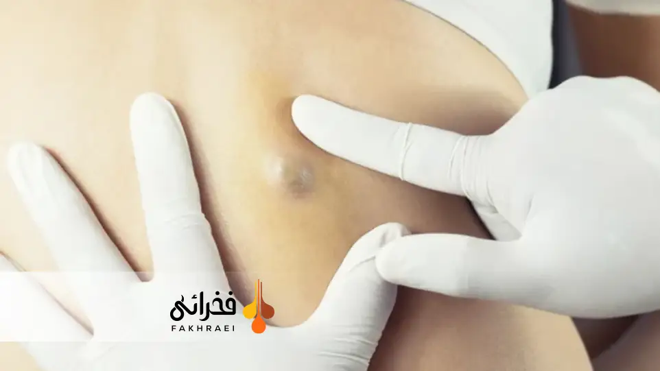 کیست کراتین چیست؟