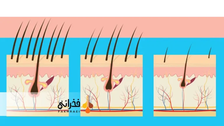 ارتباط DHT و ریزش موی مردانه