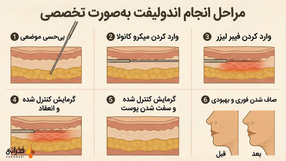 مراحل انجام اندولیفت به‌صورت تخصصی