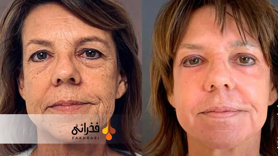 قبل و بعد استفاده از پیلینگ فنول