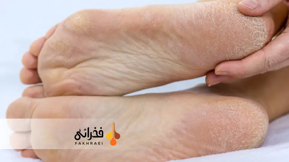 هایپرکراتوز